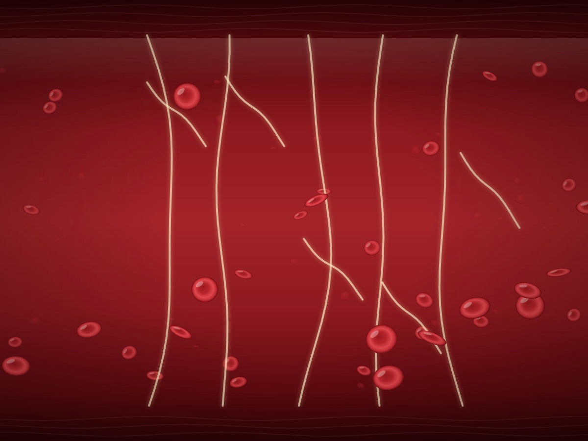 Illustration of more fibrin strands slowing blood cells